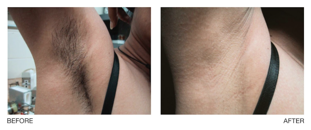 laser hair removal armpit before and after